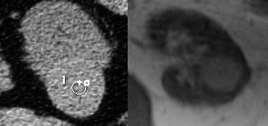 LEFT: NECT shows a lesion with a density of 27 HU.....IgnoreRIGHT: MRI shows a intrarenal lesion that is hyperintense on T1: higher signal than water...... Follow