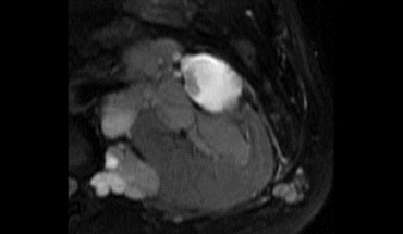 T2WI shows a multiloculated cystic mass with multiple nodules ..... Excise