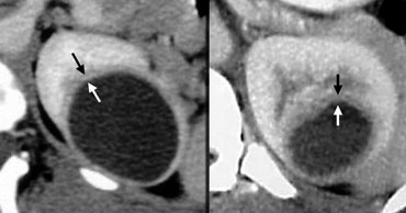 Two cysic lesions with a regular thick wall ..... Excise