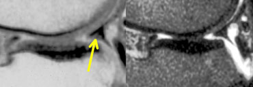 PD and T2W images. Prior partial meniscectomy and suture repair. At arthroscopy, there was no tear.