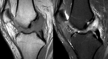 ACL Mucoid degeneration. This patient had an operation for another reason and the surgeons called it normal because it looks normal.