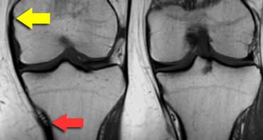 MCL from medial epicondyle (yellow arrow) to below the inferomedial geniculate vessels (red arrow) about 7 centimetres below the joint space.