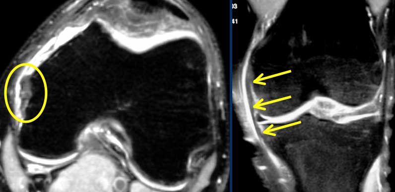 Grade 1 MCL Sprain