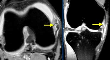 Grade II MCL Sprain