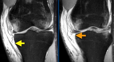 Superficial MCL-tear (yellow arrow) and deep MCL tear (orange arrow).