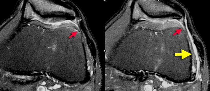 Iliotibial Band Friction syndrome : Fluid  within a bursa is seen between the iliotibial tract and the femur (yellow arrows). Joint fluid stops at the red arrows.