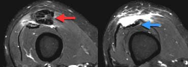 LEFT: Torn tendon with pre-existing tendinopathy (red arrow). RIGHT: Intact vastus intermedius tendon.