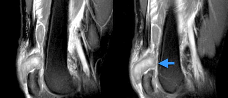 Complete quadriceps tear. Sag T2W-images. No continuity. Hematoma in between.