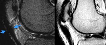 Patellar tendinopathy and Partial patellar tendon tear