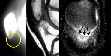 Patellar sleeve avulsion. Fractureline only visible on the coronal images.