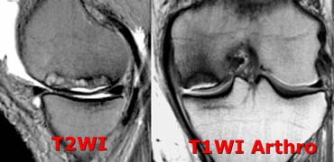 Avascular Necrosis: fluid underneath the cartilage just like a crescent sign on a X-ray. Cartilage is normal.