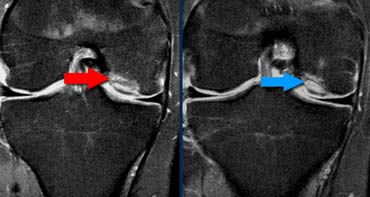 Unstable Osteochondritis Dissecans