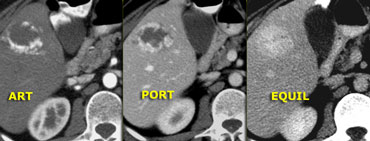 Typical hemangioma with nodular peripheral enhancement.