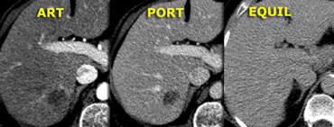 Aspecific hypovascular lesion on CT