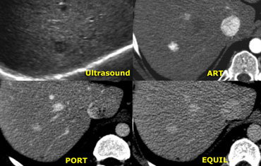 Small hemangioma atypical on US, showing typical enhancement of small hemangioma on CT.