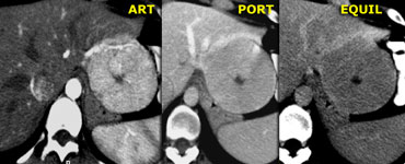 Atypical FNH with non-enhancing central scar