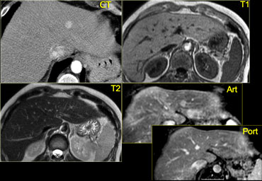 Incidental hypervascular lesion on a CTA for pulmonary emboli