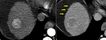 HCC: hypervascular lesion in a cirrhotic liver