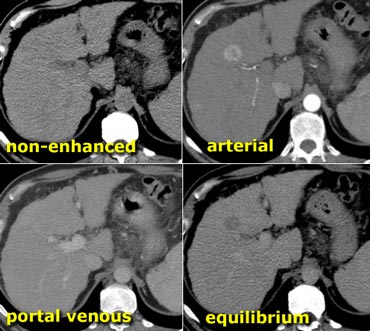 HCC in a cirrhotic liver. Notice fast wash out in equilibrium phase compared to surrounding liver parenchyma.