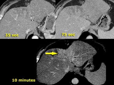 Cholangiocarcinoma with relative hyperdense scar tissue in the equilibrium phase (arrow).