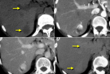 Typical hemangioma matches the bloodpool in every phase.