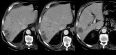 Liver abcess in a patient with diverticulitis.