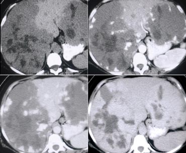 Giant hemangiomas with scar-tissue. Notice that the enhancement matches the bloodpool in all phases. Central scar is hypodens on NECT and stays hypodens.