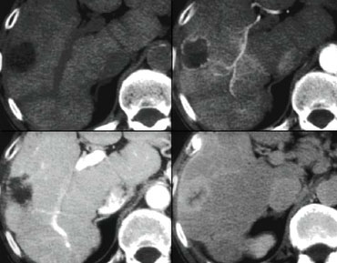 Liver lesion showing nodular enhancement, progressive fill in and delayed enhancement.