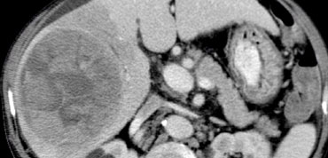 Large HCC with mozaik pattern in a non cirrhotic patient.