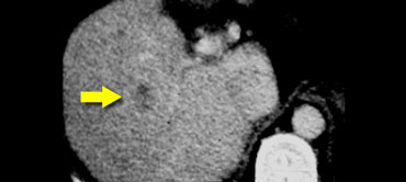 Hypovascular HCC seen in late portal venous phase