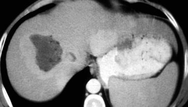 Enhancing adenoma with fat in the center