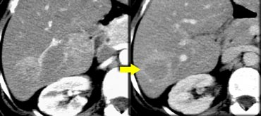 Adenoma showing capsule in delayed phase