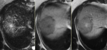 T2WI, T1WI without Gadolineum and a delayed phase after Gadolineum.