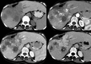 Cholangiocarcinoma: Non enhanced, arterial, portal venous and equilibrium phase.