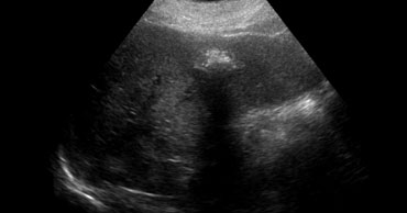 Calcified metastasis in a patient with colon cancer.