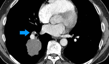 T2 tumor (> 3cm) in the right lower lobe with ipsilateral hilar node (N1)