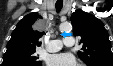 N2-disease – Right sided tumor with ipsilateral mediastinal nodes