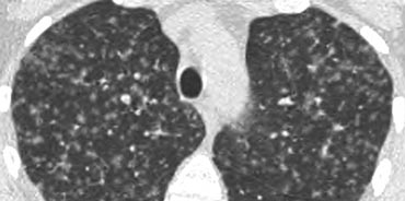 Langerhans cell histiocytosis: early nodular stage before the typical cysts appear.