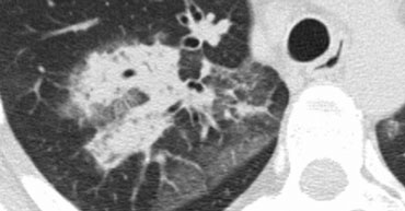 Broncho-alveolar cell carcinoma with ground-glass opacity and consolidation