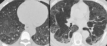 LEFT: No fibrosis, so potentially treatable lung disease. RIGHT: Fibrosis, so no treatable lung disease.