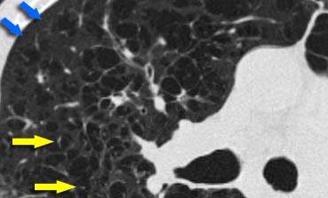 Centrilobular emphysema due to smoking. The periphery of the lung is spared (blue arrows). Centrilobular artery (yellow arrows) is seen in the center of the hypodense area.