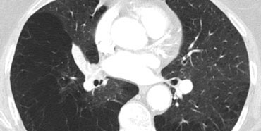 Panlobular emphysema