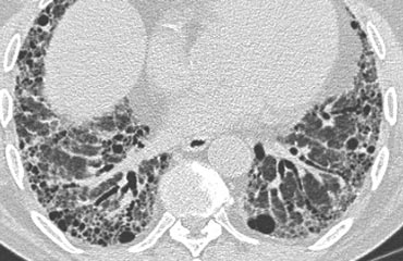 Honeycombing and traction bronchiectasis in UIP.