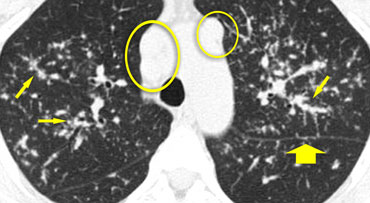 Sarcoidosis: typical presentation