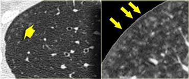 Subacute hypersensitivity pneumonitis with ill-defined centrilobular nodules