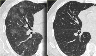 LEFT: HRCT at presentation. RIGHT: HRCT ten days later