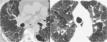 UIP with honeycombing (left) and chronic HP (right)