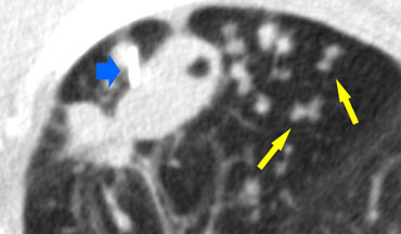 TB: cavitating lesion and endobronchial spread