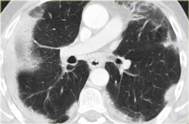 Chronic eosinophilic pneumonia