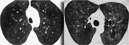 LEFT: RB-ILD in smoker. RIGHT: Hypersensitivity pneumonitis in non-smoker